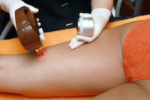 Optez pour l'épilation permanente laser : un choix malin !